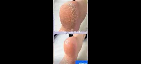 عناية بالاقدام